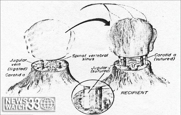 Paralyzed Russian Man First To Undergo Human Head Transplant Surgery