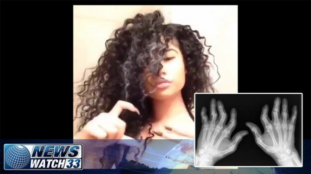 Atlanta Teen Gets Hand Amputated After Doing Rich Gang Challenge